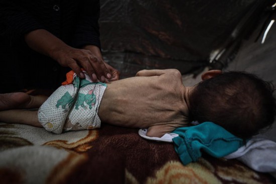 这是5月28日在加沙城西部一处临时安置点拍摄的一名营养不良的婴儿。新华社发(马哈茂德·扎基摄)