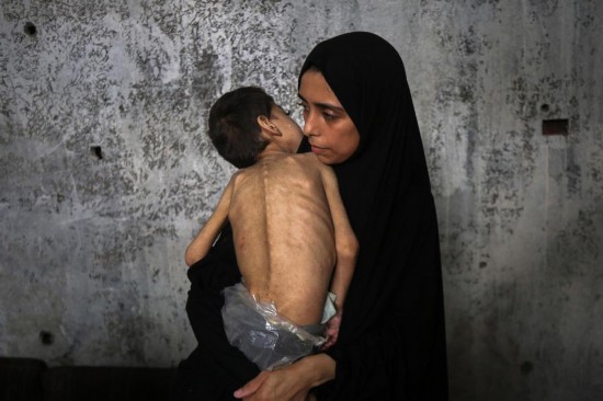 　　7月25日，在加沙城一处避难所，一名女子怀抱营养不良并患病的儿童。新华社发（里泽克·阿卜杜勒贾瓦德摄）
